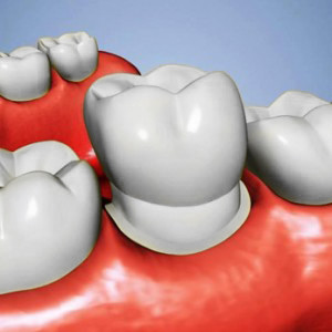 Dental Caps | Tooth Cap | Crowns on Teeth | Capped Teeth