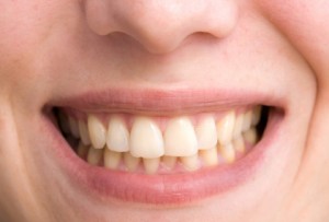 What causes yellow teeth?