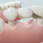 Why Do I Need a Bridge  » Dr Stone DDS