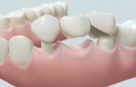Why Do I Need a Bridge » Dr Stone DDS