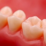 Periodontal Disease