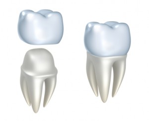 Dental Caps | Tooth Cap