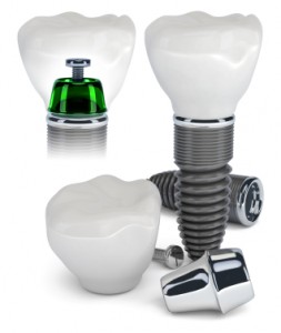 Implant dentar