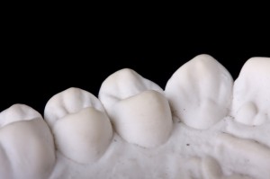 Capped Teeth: Dental impression