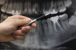 cheap-dental-implants-exact-placement
