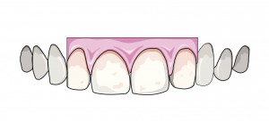 Crown Tooth Pain: Gumline