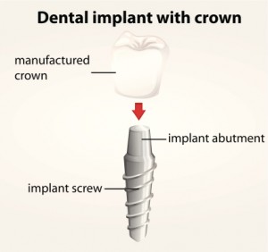 dental implant with crown