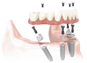 All-on-4-dental-implants