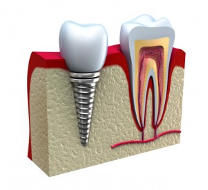 dental implant in jaw bone