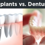 Dentures vs Implants