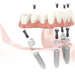 All-on-4 dental implants