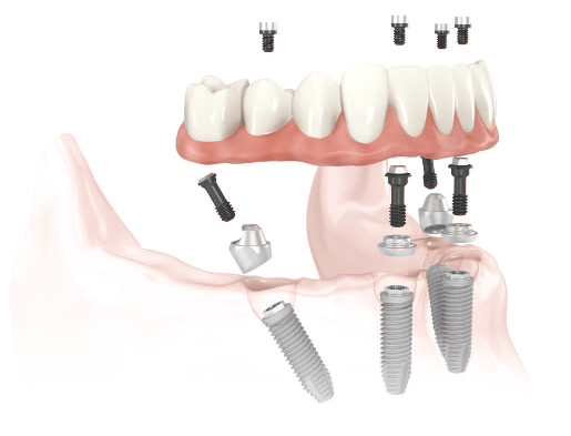 all-on-4-dental-implants2