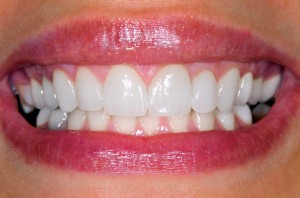 Teeth Reconstruction Dental Veneers