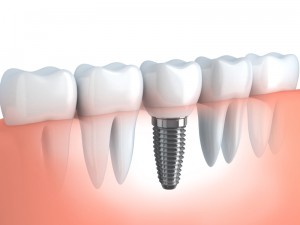 Dental Implant Specialist