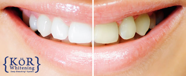Teeth Whitening kor