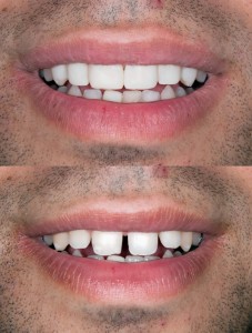 Veneers before & after