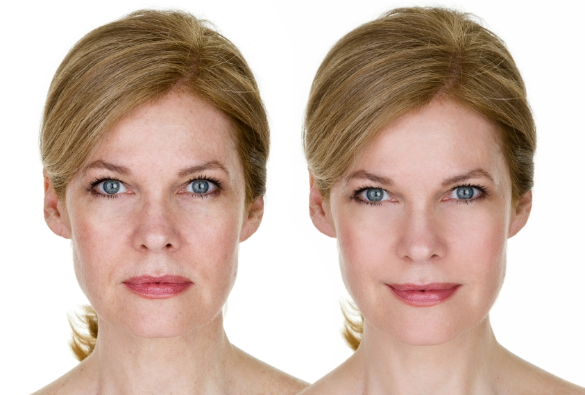 Are Botox and Juvederm Safe? - Dr. Stone, DDS