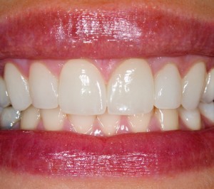 Dental  Veneers 