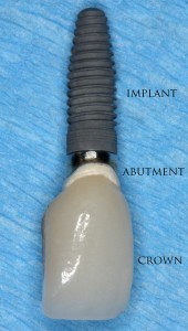 Single crown implant