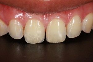 Cracked Tooth Repair - Dr. Stone, DDS