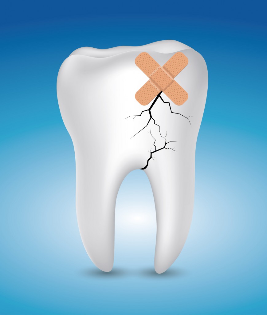 Cracked Tooth Syndrome How To Repair Cracked Teeth Dr Stone Dds