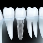 Dentures vs Implants