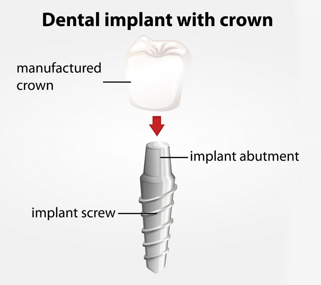 Dental implants for replacing a tooth that was extracted