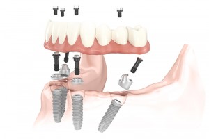 All on Four Dental Implants