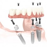 Dental Implant Alternatives