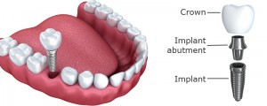 Single-dental-Implant