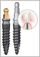 mini dental implants vs traditional implants