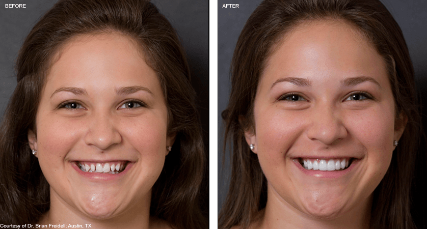 Are Veneers Covered by Insurance? Unveil the Truth