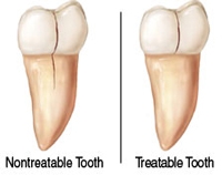 Cracked Tooth Repair - Broken Tooth Repair - Coral Springs Dentist