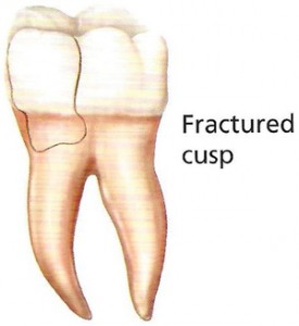 Fractured cusp
