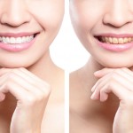 veneers cost