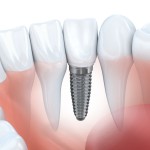 Cost of dental implants - Dental implant