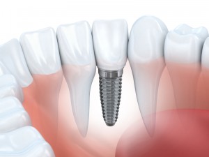 Cost of dental implants - Dental implant