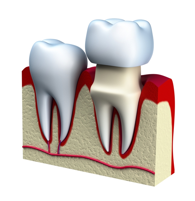 Cap Dental Dental Caps and Crowns Dr. Stone, DDS