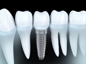 Tooth Implant Cost - Single Tooth Implant