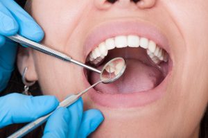 Cracked Tooth Repair