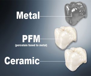 Materials used for dental crowns