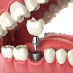 the Difference Between a Tooth Bridge and an Implant