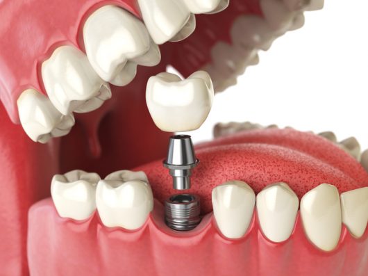 Single Tooth Dental Implant Cost