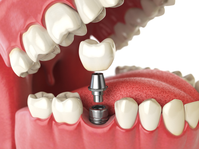 the Difference Between a Tooth Bridge and an Implant