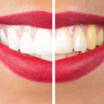 Yellowing Teeth – Causes and Whitening Methods