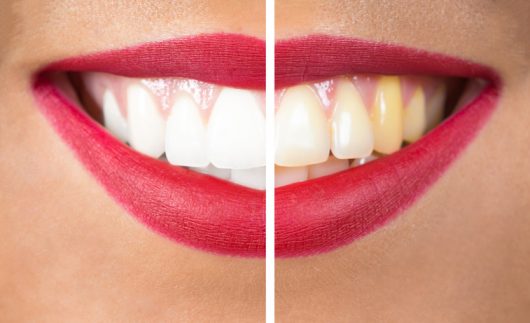 Yellowing Teeth – Causes and Whitening Methods