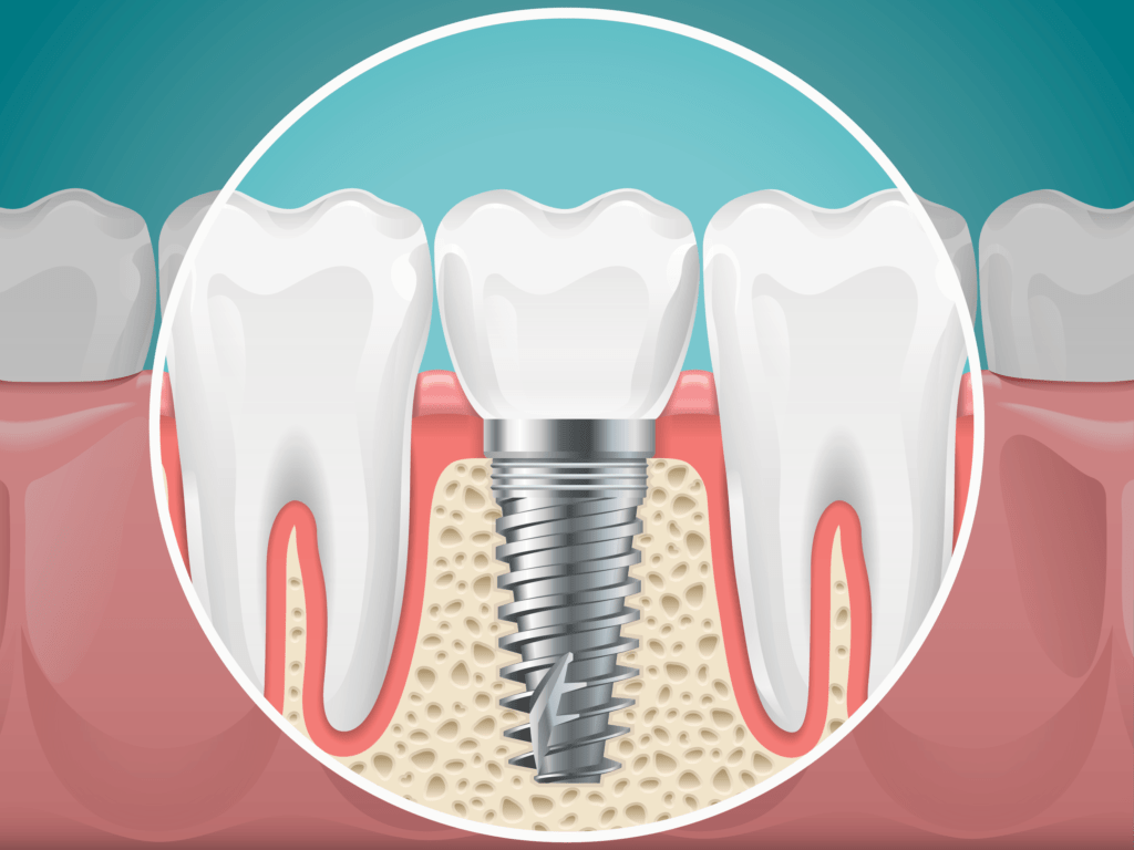 dental implant