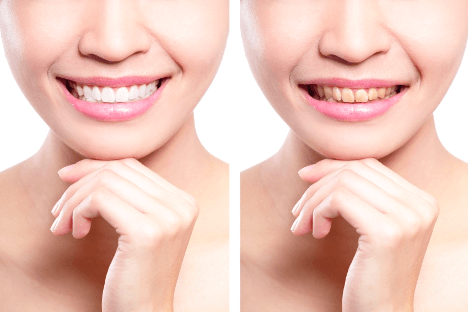 veneers and discoloration